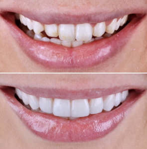 Zirconia crown